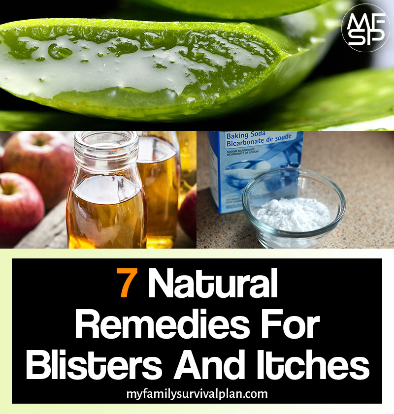 7 Natural Remedies For Blisters And Itches